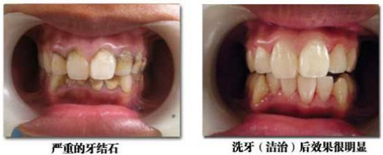 传统正畸