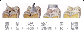 窝沟封闭的过程