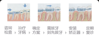 儿童牙齿矫正过程