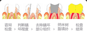 蛀牙补牙过程过程