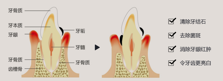 隐形矫正的优点
